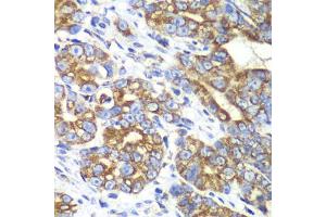 Immunohistochemistry of paraffin-embedded human gastric cancer using RALB antibody (ABIN6293713) at dilution of 1:100 (40x lens). (RALB 抗体)