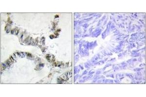 Immunohistochemistry analysis of paraffin-embedded human colon carcinoma, using SMF Antibody.