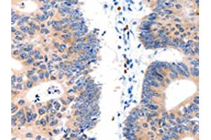 The image on the left is immunohistochemistry of paraffin-embedded Human colon cancer tissue using ABIN7130064(LAT2 Antibody) at dilution 1/15, on the right is treated with fusion protein. (LAT2 抗体)