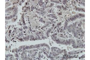 Immunoperoxidase of monoclonal antibody to FOXO3A on formalin-fixed paraffin-embedded human colon adenocarcinoma. (FOXO3 抗体  (AA 361-460))
