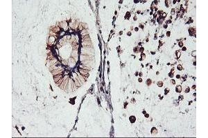 Immunohistochemical staining of paraffin-embedded Adenocarcinoma of Human colon tissue using anti-FBXO21 mouse monoclonal antibody. (FBXO21 抗体)