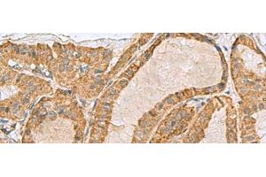 Immunohistochemistry of paraffin-embedded Human thyroid cancer tissue using PREPL Polyclonal Antibody at dilution of 1:55(x200) (PREPL 抗体)