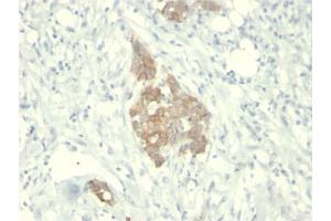 Formalin-fixed, paraffin-embedded human Breast Carcinoma stained with RET Mouse Monoclonal Antibody (RET/2795). (Ret Proto-Oncogene 抗体  (AA 702-848))