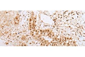 Immunohistochemistry of paraffin-embedded Human colorectal cancer tissue using ZNF22 Polyclonal Antibody at dilution of 1:25(x200) (Zinc Finger Protein 22 抗体)