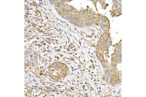 Immunohistochemistry of paraffin-embedded human colon carcinoma using SOCS1 Rabbit pAb (ABIN6128737, ABIN6148263, ABIN6148266 and ABIN6223700) at dilution of 1:250 (40x lens). (SOCS1 抗体  (AA 1-211))