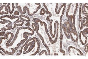 IHC-P Image Immunohistochemical analysis of paraffin-embedded human ovarian cancer, using ACADM, antibody at 1:100 dilution. (Medium-Chain Specific Acyl-CoA Dehydrogenase, Mitochondrial (C-Term) 抗体)