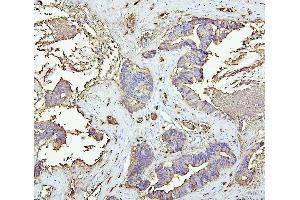 IHC analysis of CEACAM5 using anti-CEACAM5 antibody (ABIN7601435).