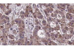 ABIN6273877 at 1/100 staining Human liver cancer tissue by IHC-P. (Prostaglandin D2 Receptor 2 (PTGDR2) (Internal Region) 抗体)