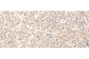 Immunohistochemistry of paraffin-embedded Human ovarian cancer tissue using RUVBL2 Polyclonal Antibody at dilution of 1:25(x200) (RUVBL2 抗体)