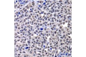 Immunohistochemistry of paraffin-embedded mouse cancer using H2AFY antibody (ABIN2562982) at dilution of 1:100 (40x lens). (H2AFY 抗体)