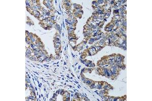 Immunohistochemistry of paraffin-embedded human gastric cancer using ATP5B antibody. (ATP5B 抗体  (AA 230-529))