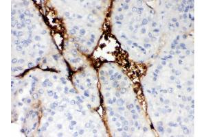 Anti-CA1 Picoband antibody, IHC(P) IHC(P): Human Liver Cancer Tissue (CA1 抗体  (AA 9-261))