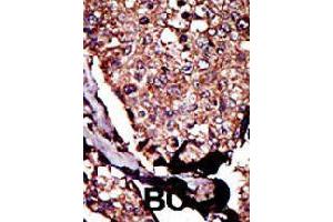 Formalin-fixed and paraffin-embedded human cancer tissue reacted with DGKB polyclonal antibody  , which was peroxidase-conjugated to the secondary antibody, followed by DAB staining. (DGKB 抗体  (C-Term))