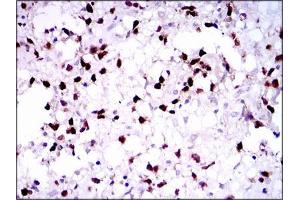 Immunohistochemical analysis of paraffin-embedded brain tumors tissues using PAX5 mouse mAb with DAB staining. (PAX5 抗体  (AA 235-382))