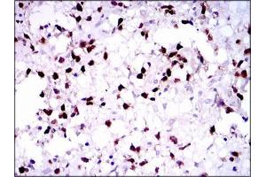 Immunohistochemical analysis of paraffin-embedded brain tumors tissues using PAX5 mouse mAb with DAB staining.