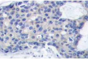 Immunohistochemistry (IHC) analyzes of p-ZAP-70 antibody in paraffin-embedded human breast carcinoma tissue. (ZAP70 抗体  (pTyr493))