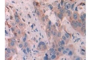 Detection of KRT6C in Human Breast cancer Tissue using Polyclonal Antibody to Keratin 6C (KRT6C) (Keratin 6C 抗体  (AA 163-482))