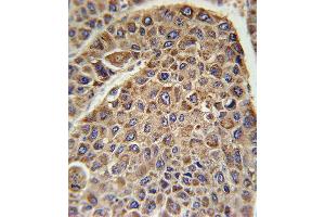 DLAT Antibody (C-term) (ABIN651534 and ABIN2840283) immunohistochemistry analysis in formalin fixed and paraffin embedded human hepatocarcinoma followed by peroxidase conjugation of the secondary antibody and DAB staining. (DLAT 抗体  (C-Term))