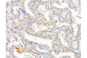 ABIN6263368 and ABIN6279540 at 1/100 staining human liver cancer by IHC-P. (MRPL33 抗体  (Internal Region))