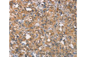 Immunohistochemistry of Human gastric cancer using CEACAM6 Polyclonal Antibody at dilution of 1:50 (CEACAM6 抗体)