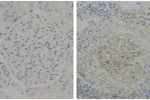 Paraffin embedded glomerular basement membrane tissue sections from patients with Anti-GBM disease were stained with Mouse Anti-Human IgG2 Fd-UNLB (小鼠 anti-人 IgG2 (Fd Region) Antibody)