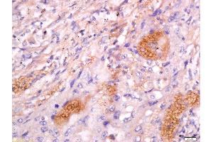 Formalin-fixed and paraffin embedded human lung carcinoma labeled with Anti-CD63/MLA1 Polyclonal Antibody, Unconjugated  at 1:200 followed by conjugation to the secondary antibody and DAB staining. (CD63 抗体  (AA 101-200))