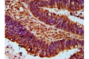 IHC image of ABIN7152566 diluted at 1:300 and staining in paraffin-embedded human ovarian cancer performed on a Leica BondTM system. (FAN1 抗体  (AA 167-373))
