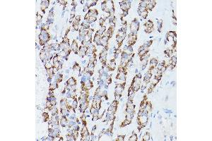 Immunohistochemistry of paraffin-embedded Human thyroid cancer using RPS18 antibody (ABIN6128660, ABIN6147205, ABIN6147206 and ABIN6215379) at dilution of 1:100 (40x lens). (RPS18 抗体  (AA 1-152))