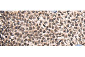 Immunohistochemistry of paraffin-embedded Human ovarian cancer tissue using CITED2 Polyclonal Antibody at dilution of 1:50(x200) (CITED2 抗体)