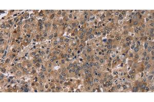 Immunohistochemistry of paraffin-embedded Human liver cancer tissue using FAM107A Polyclonal Antibody at dilution 1:30 (FAM107A 抗体)