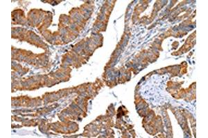 The image on the left is immunohistochemistry of paraffin-embedded Human esophagus cancer tissue using ABIN7193075(XKR4 Antibody) at dilution 1/20, on the right is treated with synthetic peptide. (XKR4 抗体)