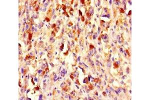 Immunohistochemistry of paraffin-embedded human melanoma using ABIN7147720 at dilution of 1:100 (CHD4 抗体  (AA 1-219))