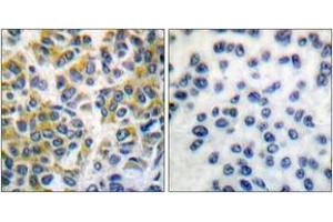 Immunohistochemistry analysis of paraffin-embedded human breast carcinoma tissue, using SHP-1 (Ab-536) Antibody. (SHP1 抗体  (AA 502-551))