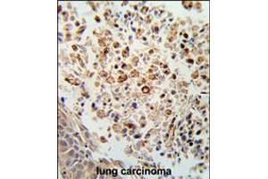 Formalin-fixed and paraffin-embedded human lung carcinoma reacted with FPRL2 Antibody , which was peroxidase-conjugated to the secondary antibody, followed by DAB staining. (FPR3 抗体  (AA 307-333))