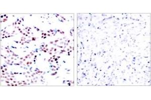 Immunohistochemistry analysis of paraffin-embedded human breast carcinoma, using c-Jun (Phospho-Thr91) Antibody.