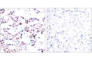 Immunohistochemistry analysis of paraffin-embedded human breast carcinoma, using c-Jun (Phospho-Thr91) Antibody. (C-JUN 抗体  (pThr91))