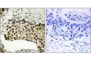 Immunohistochemistry analysis of paraffin-embedded human breast carcinoma, using MSK1 (Phospho-Ser212) Antibody. (MSK1 抗体  (pSer212))