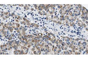 ABIN6274580 at 1/100 staining Human liver cancer tissue by IHC-P. (ADCY6 抗体  (Internal Region))