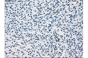 Immunohistochemical staining of paraffin-embedded Adenocarcinoma of colon tissue using anti-ZFP36 mouse monoclonal antibody. (ZFP36 抗体)