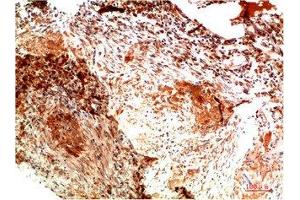 Immunohistochemical analysis of paraffin-embedded Human Lung Carcinoma Tissue using Collagen II Mouse mAb diluted at 1:200. (COL2A1 抗体)