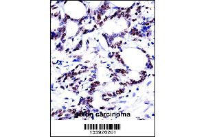 HNRNPM Antibody immunohistochemistry analysis in formalin fixed and paraffin embedded human colon carcinoma followed by peroxidase conjugation of the secondary antibody and DAB staining.