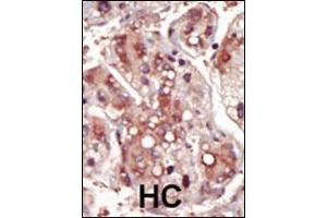 Formalin-fixed and paraffin-embedded human cancer tissue reacted with the primary antibody, which was peroxidase-conjugated to the secondary antibody, followed by DAB staining. (MEK2 抗体  (AA 262-292))