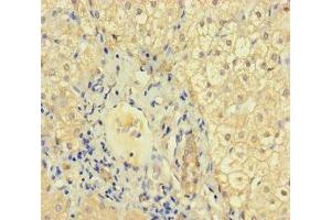 Immunohistochemistry of paraffin-embedded human liver cancer using ABIN7157448 at dilution of 1:100 (Keratin 71 抗体  (AA 201-500))
