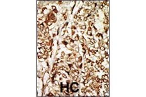 Formalin-fixed and paraffin-embedded human cancer tissue reacted with the primary antibody, which was peroxidase-conjugated to the secondary antibody, followed by AEC staining. (MOS 抗体  (N-Term))