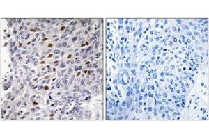 Immunohistochemistry analysis of paraffin-embedded human lung carcinoma tissue, using ATF1 (Ab-63) Antibody. (AFT1 抗体  (AA 31-80))