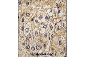 Formalin-fixed and paraffin-embedded human hepatocarcinoma tissue reacted with EphA7 antibody (ABIN391900 and ABIN2841718) , which was peroxidase-conjugated to the secondary antibody, followed by DAB staining. (EPH Receptor A7 抗体)