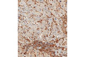 Immunohistochemical analysis of paraffin-embedded Human hepatocarcinoma tissue using A performed on the Leica® BOND RXm. (Annexin V 抗体  (N-Term))