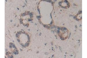 Detection of ICAM2 in Human Bile duct cancer Tissue using Polyclonal Antibody to Intercellular Adhesion Molecule 2 (ICAM2) (ICAM2 抗体  (AA 34-241))