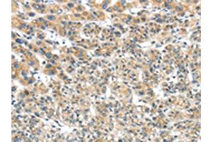 The image on the left is immunohistochemistry of paraffin-embedded Human liver cancer tissue using ABIN7131474(TRIM16 Antibody) at dilution 1/35, on the right is treated with fusion protein. (TRIM16 抗体)