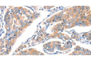 Immunohistochemistry of paraffin-embedded Human breast cancer using CD297 Polyclonal Antibody at dilution of 1:30 (ART4 抗体)